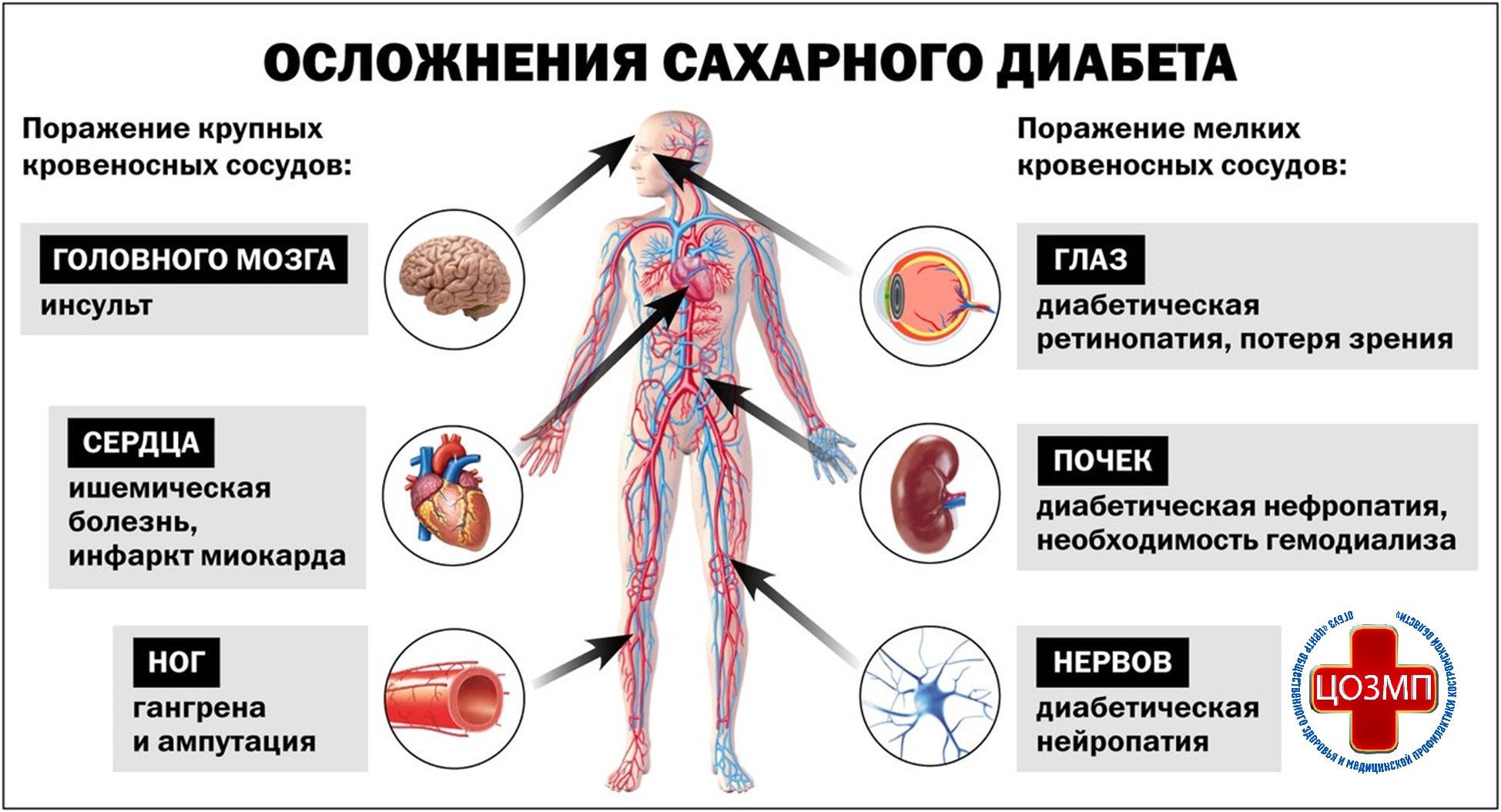 Осложнения СД.jpg