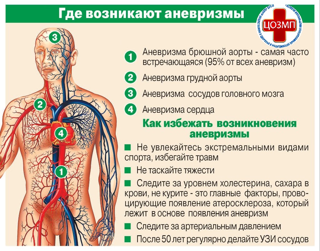 где возникают аневризмы.jpg
