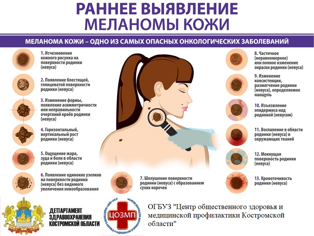 мелонома.jpg